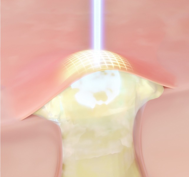 アップルレーザー image